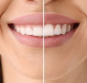 Sonrisa gingival